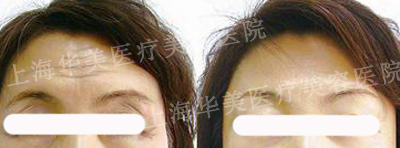 抬头纹怎样祛除
