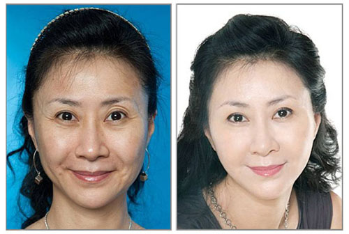除皱手术后需要多久才可以上班