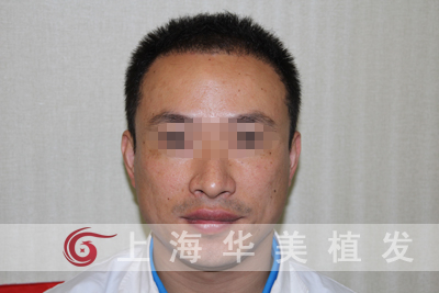 植发手术后会不会对皮肤产生危害,留下疤痕呢