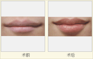 嘴唇太厚如何是好