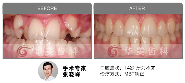 门牙缝大:矫正vs贴面=两年:一旬
