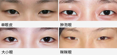 Park重睑适合人群