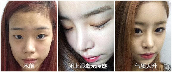 双眼皮术后分享