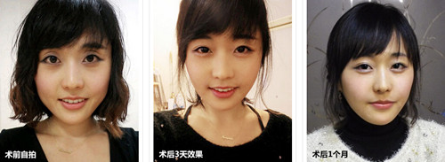 卧蚕后,看起来年轻了好几岁