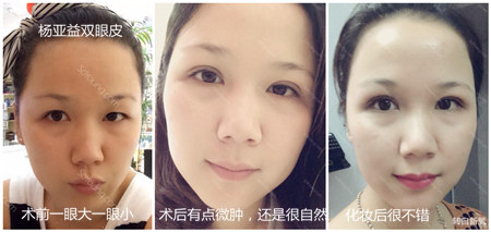 杨亚益定制park法重睑效果