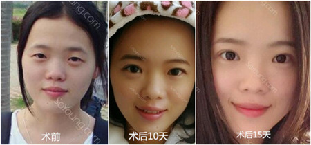 杨亚益定制park法重睑效果