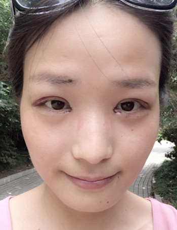park法重睑术4