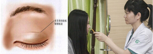 什么是定制park法重睑术