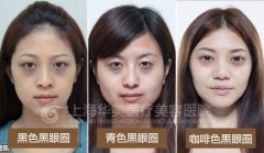 怎么去除黑眼圈