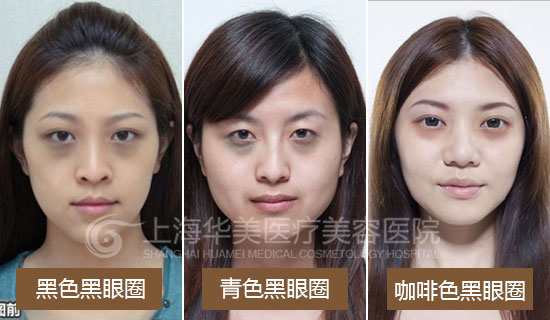 这些颜色一般预示了你的黑眼圈类型