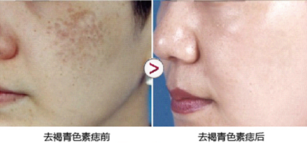 激光去痣好吗