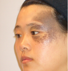 太田痣