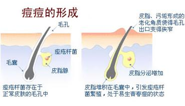 彻底清洁,消炎杀菌