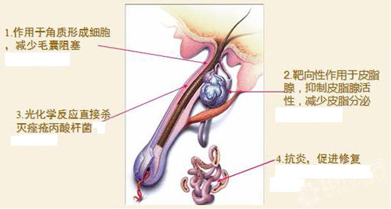 对症治疗,拔除痘根