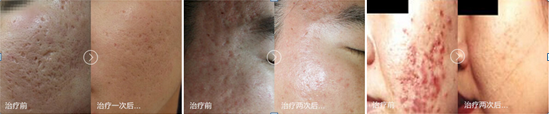 1次告别痘坑痘印痘疤