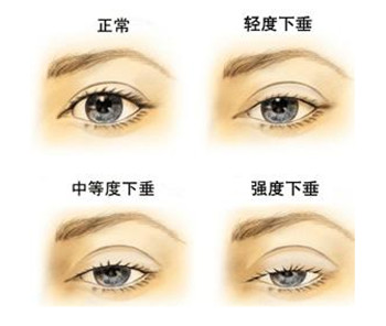 上睑下垂的临床表现以及最佳矫正时间