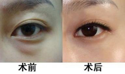 眼袋还有什么危害