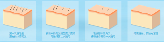 冰点脱毛有周期,三次即可永久去除