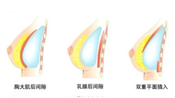 假体隆胸会不会影响到以后的哺乳