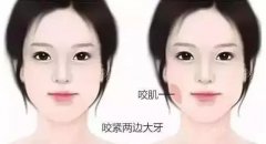 瘦脸针间隔多久打一次比较好?