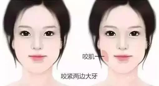 瘦脸针间隔多久打一次比较好?
