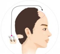 植发后长出来的头发跟正常头发有区别吗?